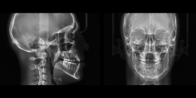 MYRAY X9 PRO 3D Ceph